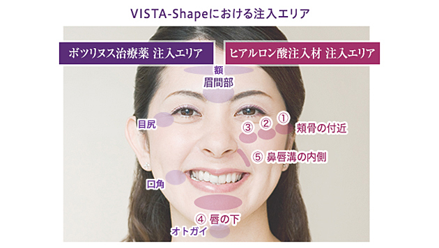 VISTA-Shapeにおける注入部位と量の目安
