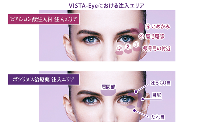 VISTA‐Eyeにおける注入部位
