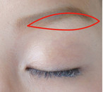 拡大眉毛下皮膚切除の位置