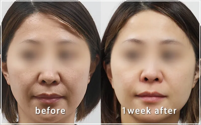 共立美容外科のケミカルピーリングの症例写真