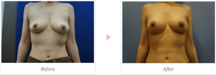湘南美容クリニックの豊胸手術の症例写真