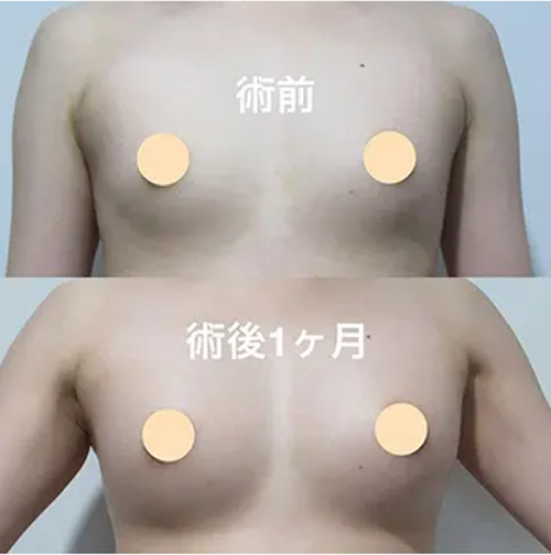 共立美容外科の豊胸手術の症例写真