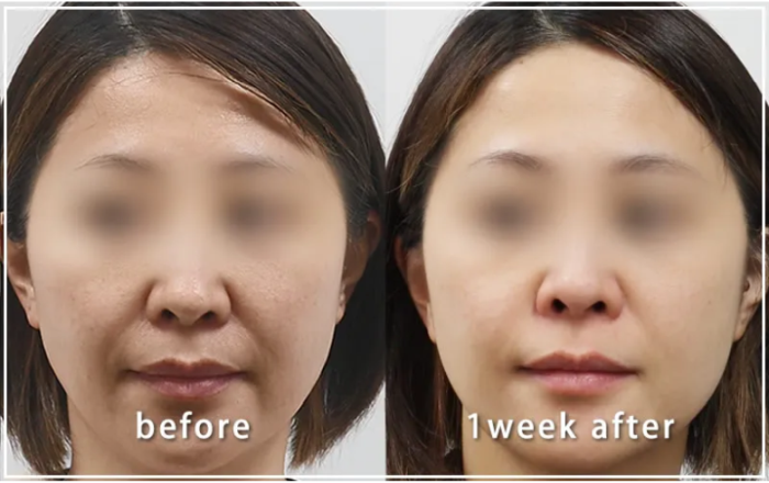 共立美容外科 名古屋院のケミカルピーリングの症例写真