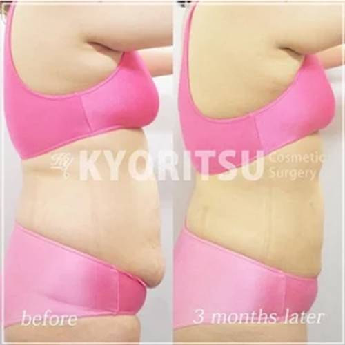 共立美容外科 大阪本院の脂肪吸引の症例写真