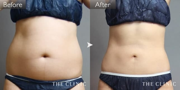 THE CLINICの脂肪吸引の症例写真