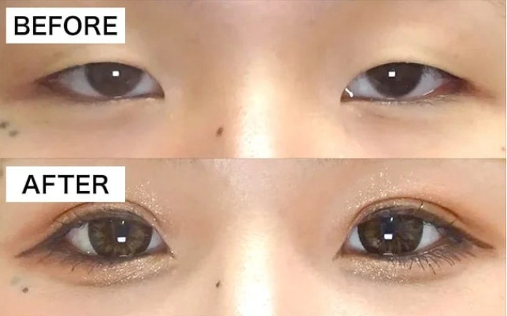 東京中央美容外科の二重埋没法の症例ビフォーアフター