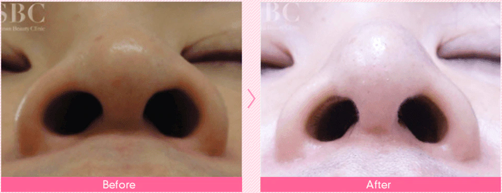 湘南美容クリニックの鼻尖形成術（だんご鼻解消）の症例写真