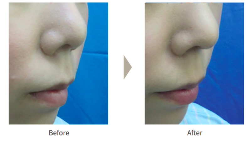 ガーデンクリニックの鼻尖形成術（だんご鼻解消）の症例写真