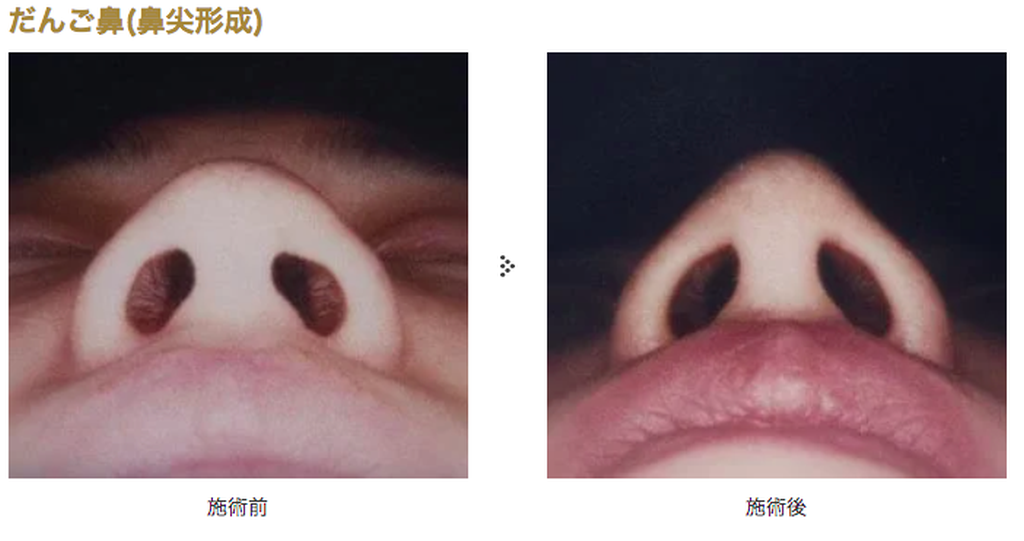 共立美容外科の鼻整形の鼻尖形成（だんご鼻解消）の症例写真