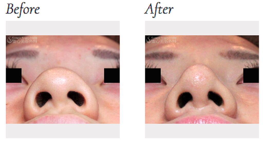 聖心美容クリニックの鼻尖形成術（だんご鼻解消）の症例写真
