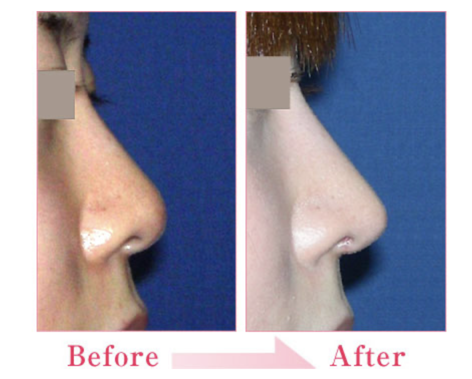 城本クリニックの鼻尖形成術（だんご鼻解消）の症例写真