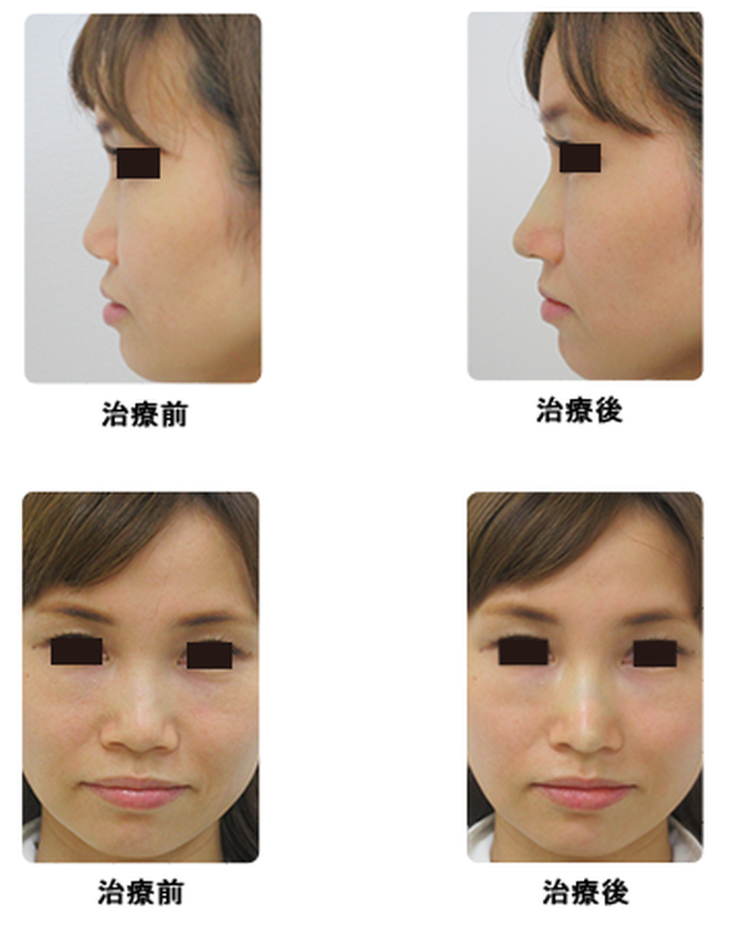 シロノクリニックの鼻尖形成（だんご鼻解消）の症例写真