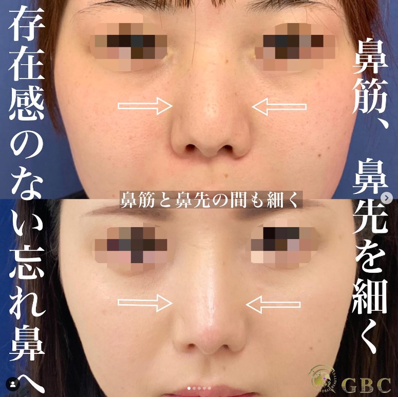 グローバルビューティークリニックの「プロテーゼ」「鼻尖形成」「鼻尖部軟骨移植」「鼻柱下降術」の症例写真