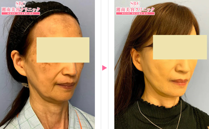 湘南美容外科　レーザー治療によるほうれい線治療　症例写真