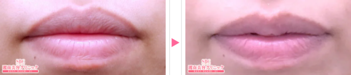 湘南美容外科の唇縮小の症例写真