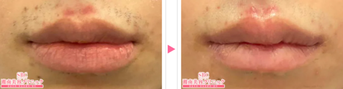 湘南美容外科の唇縮小の症例写真
