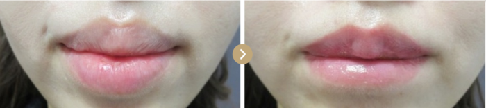 TAクリニックの唇縮小の症例写真