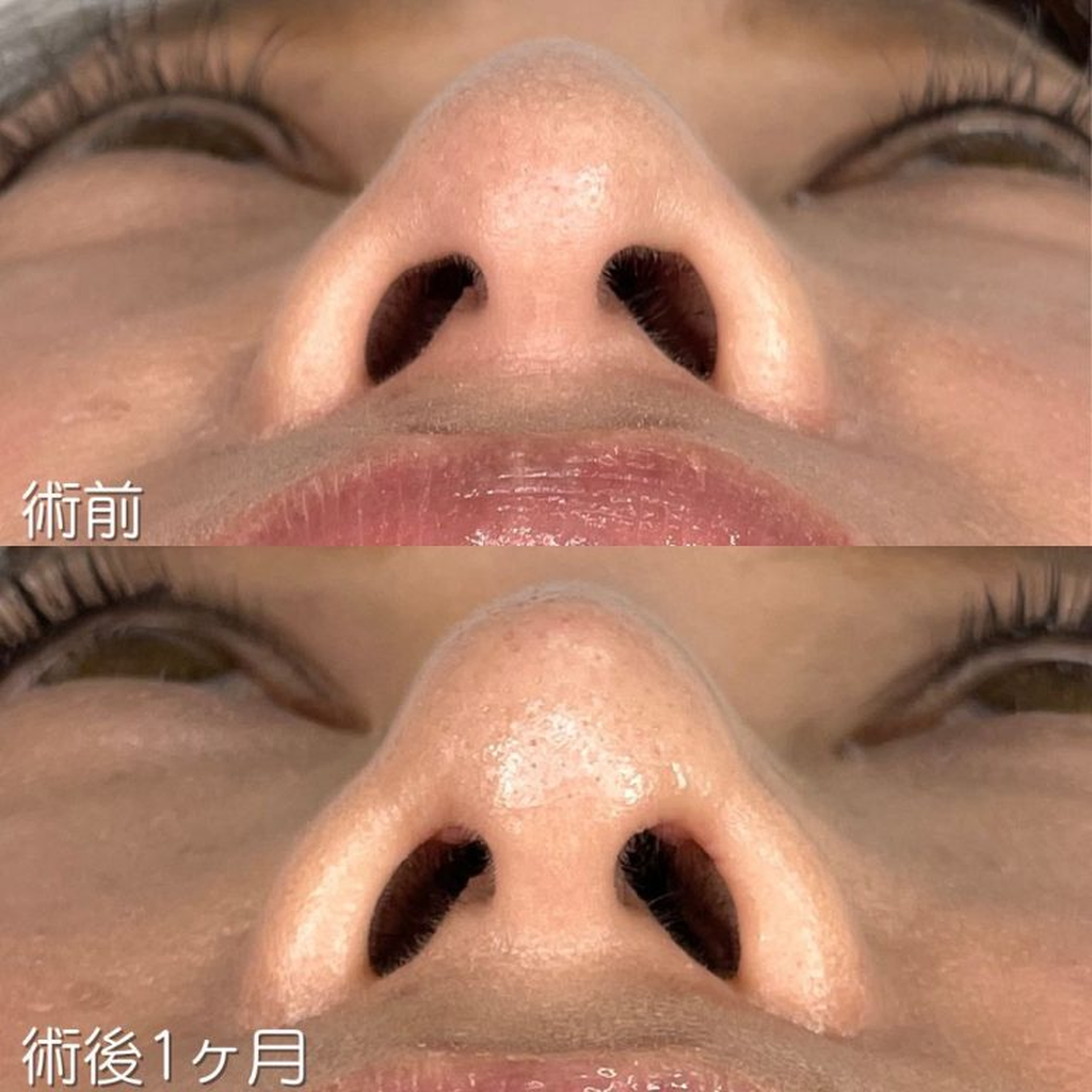 TCB東京中央美容外科　忘れ鼻整形症例写真