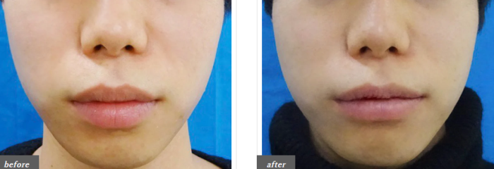 TCB東京中央美容外科の唇縮小の症例写真