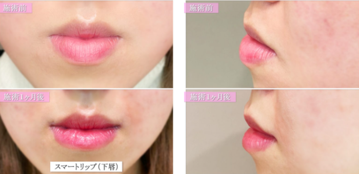 TCB東京中央美容外科の唇縮小の症例写真