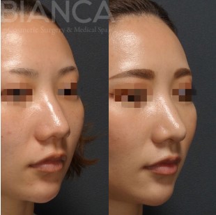 ビアンカクリニックの鼻尖形成+耳介軟骨移植の症例写真