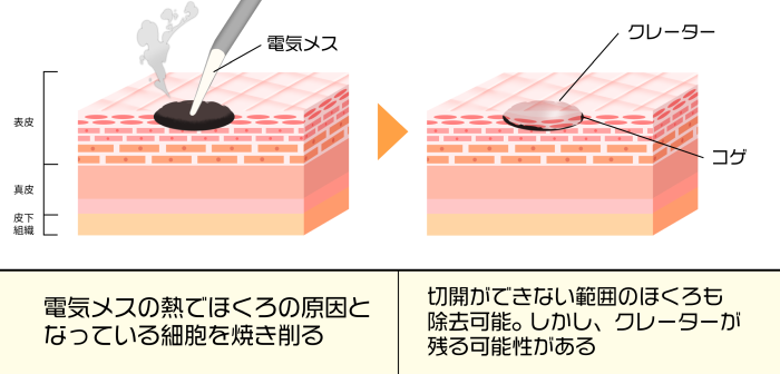 電気メスの熱でほくろの原因と なっている細胞を焼き削る　切開ができない範囲のほくろも 除去可能。 しかし、クレーターが 残る可能性がある