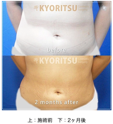 共立美容外科の脂肪吸引の症例写真