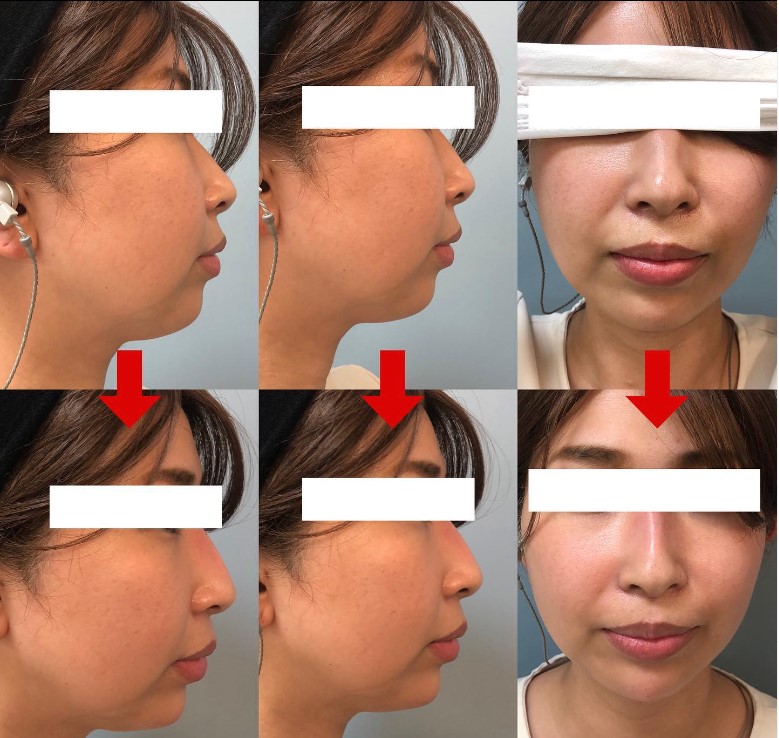 西記念神戸アカデミアクリニックの鼻ヒアルロン酸の症例写真