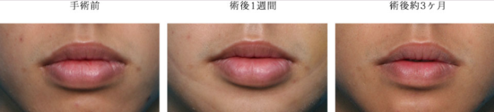 ヴェリテクリニックの唇縮小の症例写真