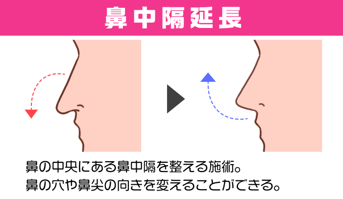 鼻の中央にある鼻中隔を整える施術。 鼻の穴や鼻尖の向きを変えることができる。