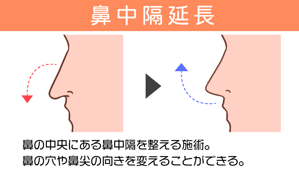 鼻の中央にある鼻中隔を整える施術。 鼻の穴や鼻尖の向きを変えることができる。