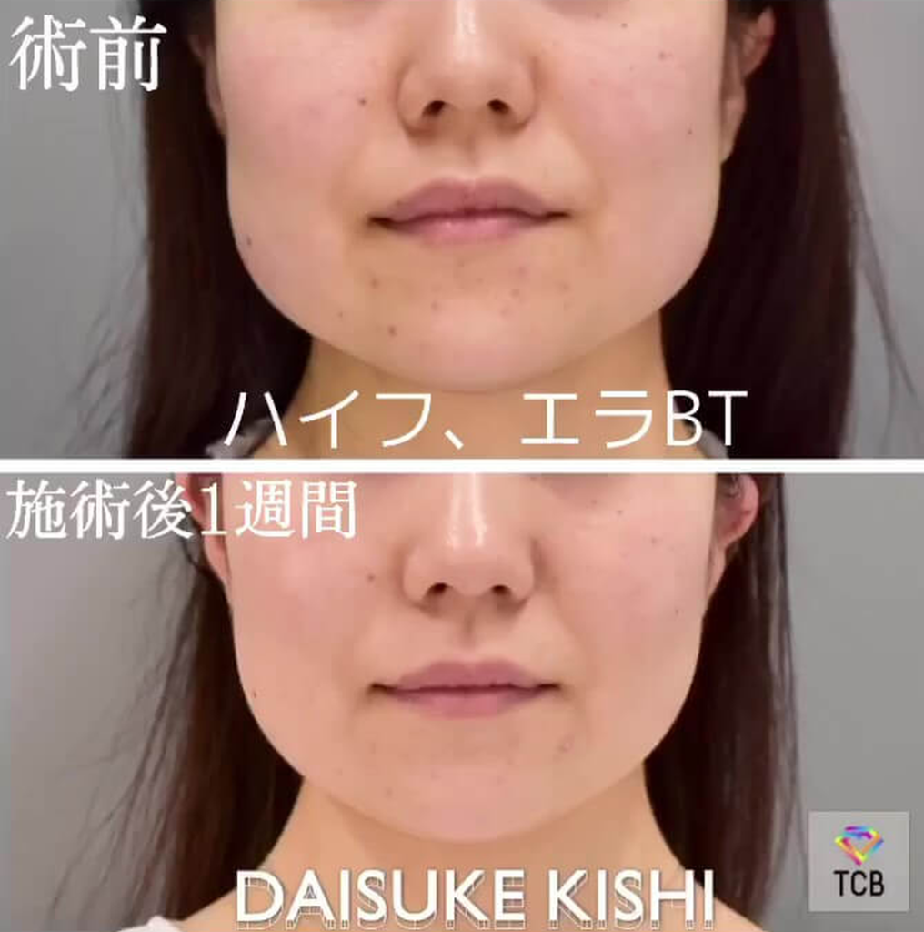 TCB東京中央美容外科のハイフの症例写真