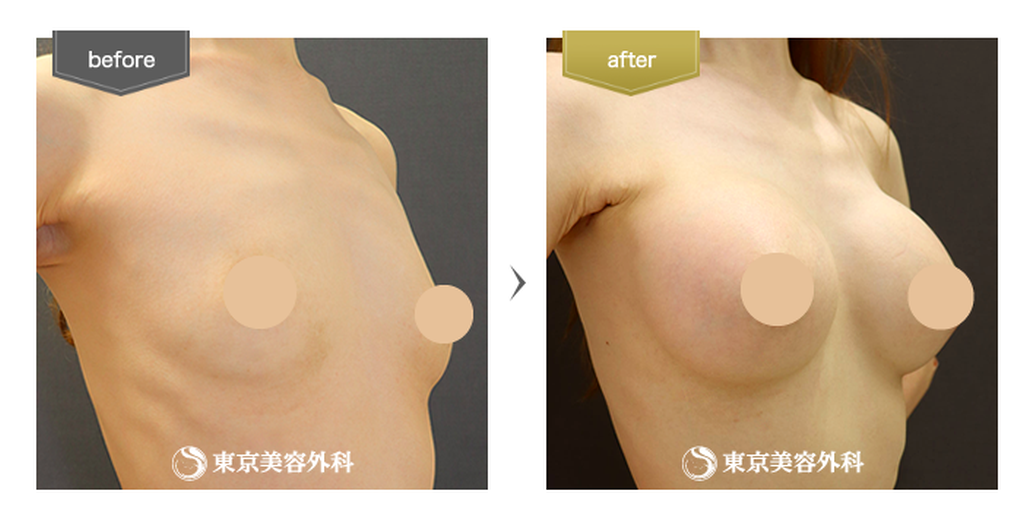 東京美容外科のシリコンバッグ豊胸の症例写真