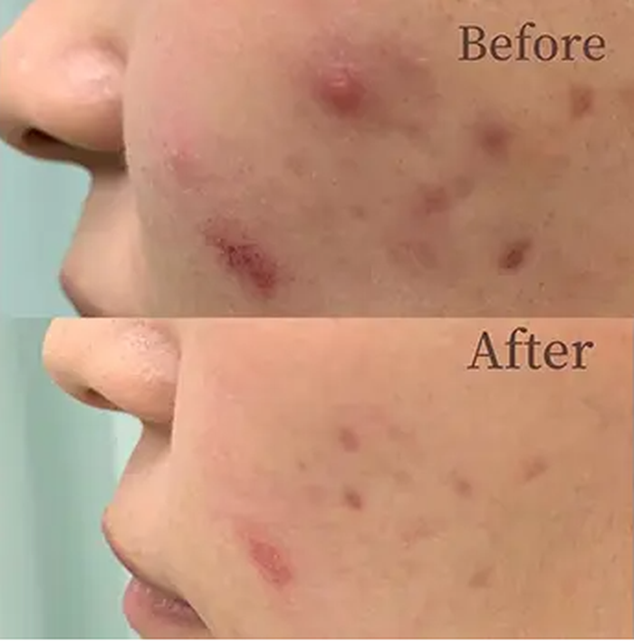 共立美容外科のニキビ跡治療の症例写真