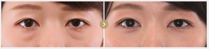 TAクリニック　下眼瞼脱脂術（目の下のたるみ取り・目の下の脂肪ふくらみ取り）＋顔の脂肪注入(コンデンスリッチフェイス)の症例写真