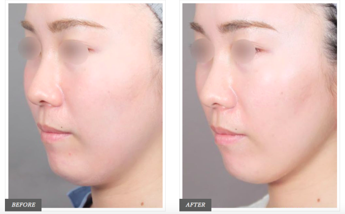 TCB東京中央美容外科の顔の脂肪吸引の症例写真