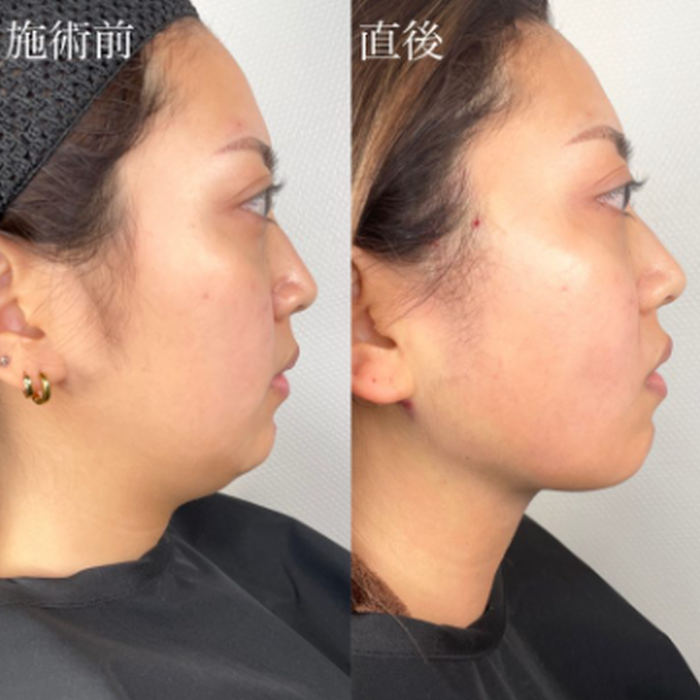 TCB東京中央美容外科のTCB式小顔脂肪吸引の症例写真