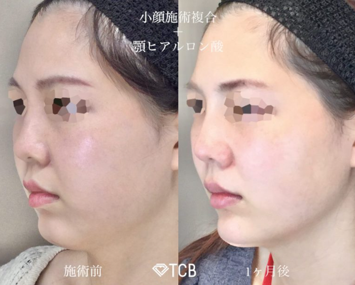 TCB東京中央美容外科のTCB小顔リフトの症例写真
