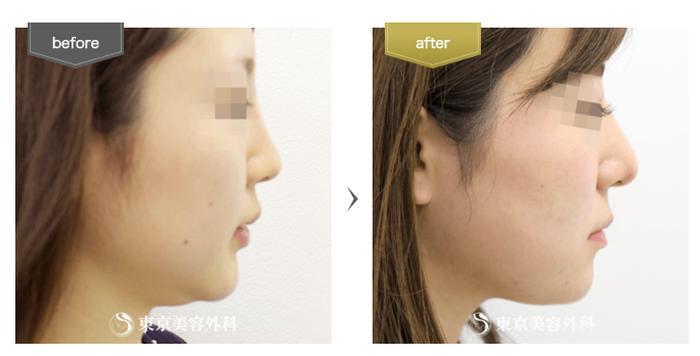 東京美容外科の顎のヒアルロン酸注射の症例写真