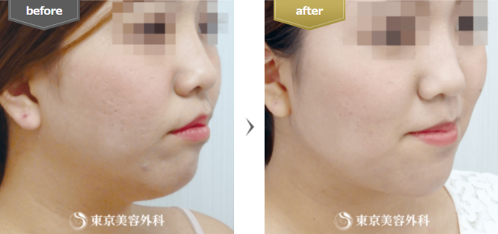 東京美容外科の脂肪吸引（フェイスライン）の症例写真