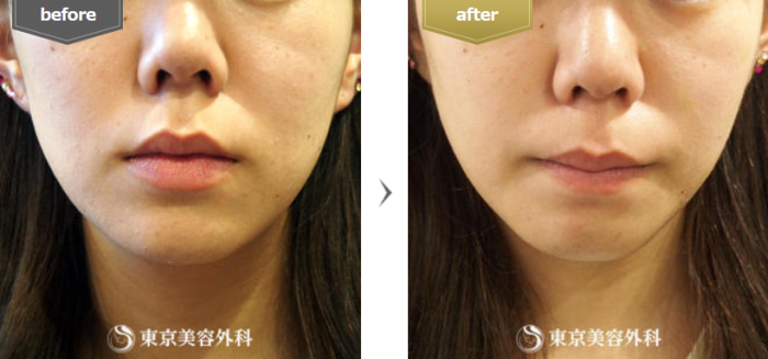 東京美容外科の小顔BNLS注射の症例写真