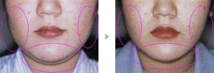 共立美容外科の顔の脂肪吸引の症例写真
