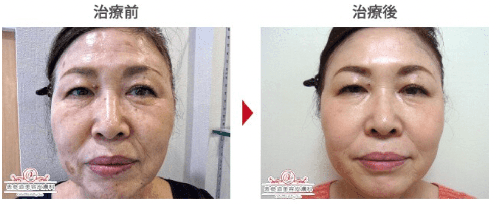 表参道美容皮膚科 原宿本院：フォトシルクプラス顔全体　1回の症例写真