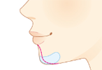 顎のプロテーゼ