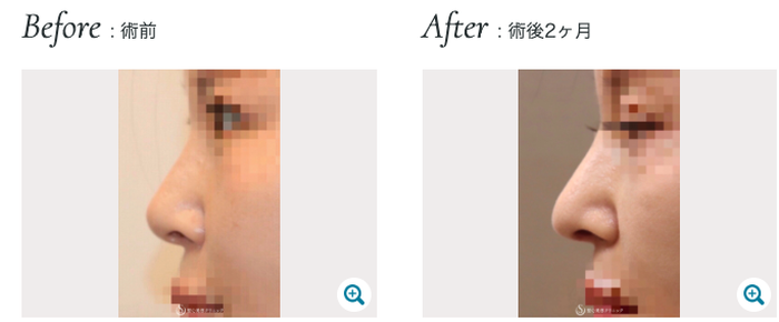 聖心美容クリニックの鼻中隔延長術+鼻尖形成術（耳介軟骨移植）の症例写真