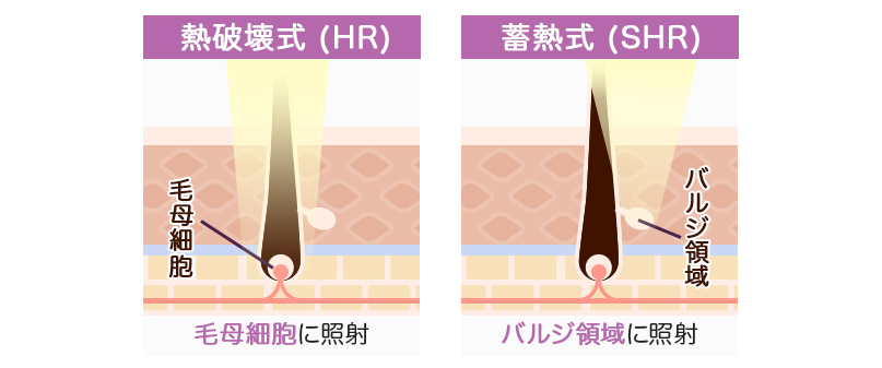 医療脱毛機の熱破壊(hr)と蓄熱式(shr)の照射方法の違い
