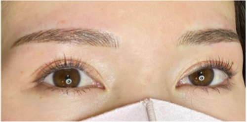 エルムクリニックの眉 4D（毛並み + パウダーブロウ）の症例写真