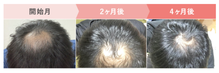 クリニックフォア：AGA治療：発毛ライトプラン（フィナステリド+ミノキシジル内服薬）／スカルプケアサプリ1ヶ月の症例写真