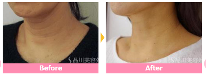 品川美容外科の首のシワ整形の症例写真