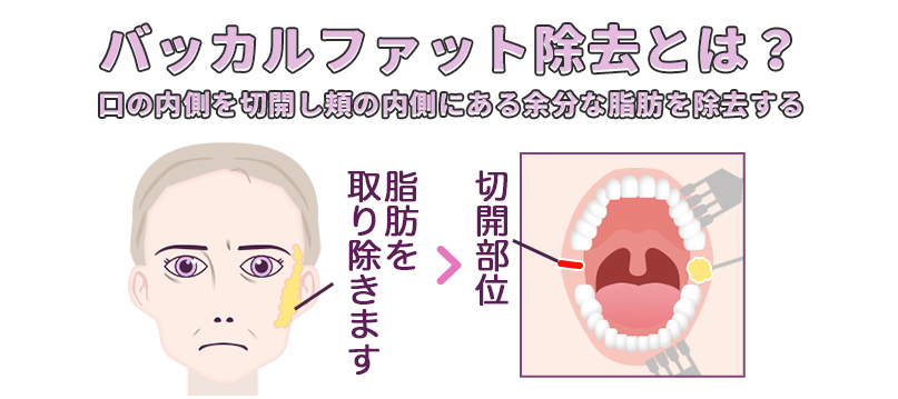 バッカルファット除去とは？口の内側を切開し頬の内側にある余分な脂肪を除去する